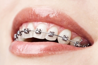 Gum Recessions & Braces | My Smile Orthodontics