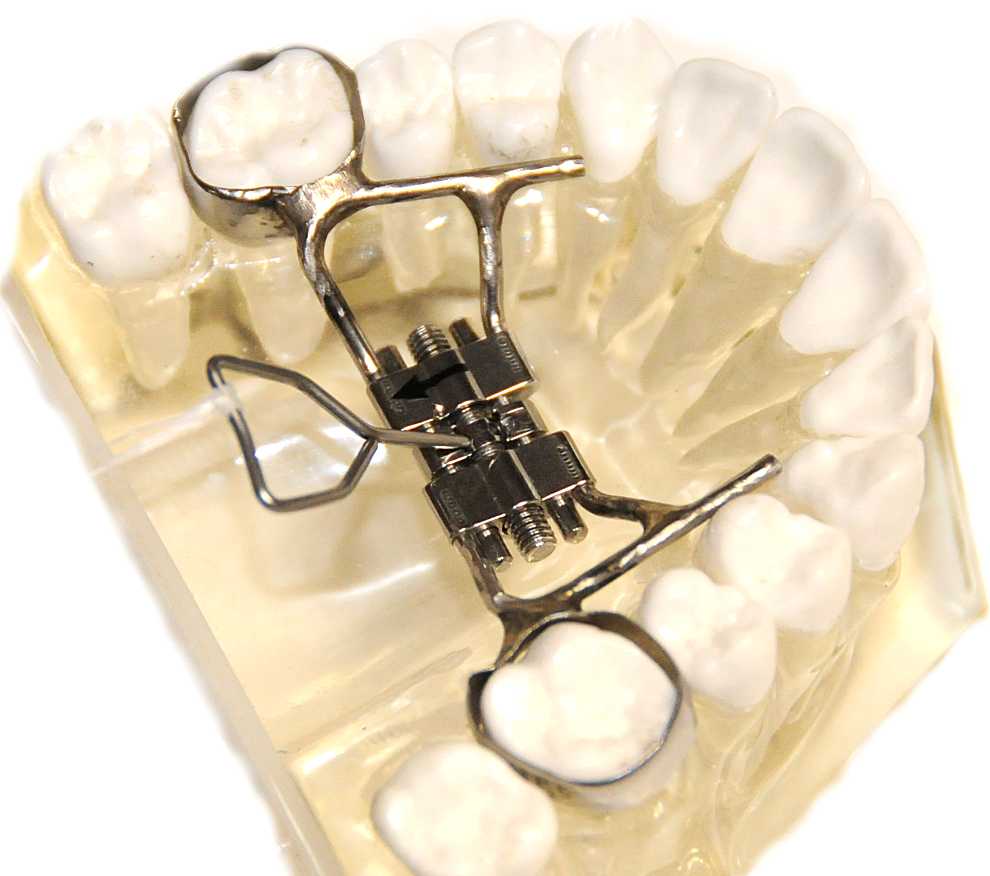 6 Things You Need To Know About The Rapid Palatal Expander