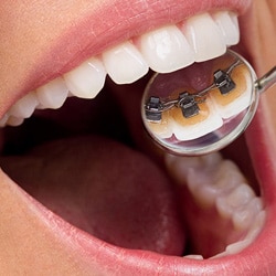 Get the Facts on Inside Braces | mysmilect