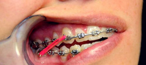 The Importance Of Orthodontic Elastics | MySmileCT Blog