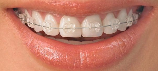 Affordable Braces-Less Expensive Than You Think
